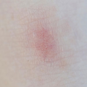 건선 초기 증상 - 붉은 반점