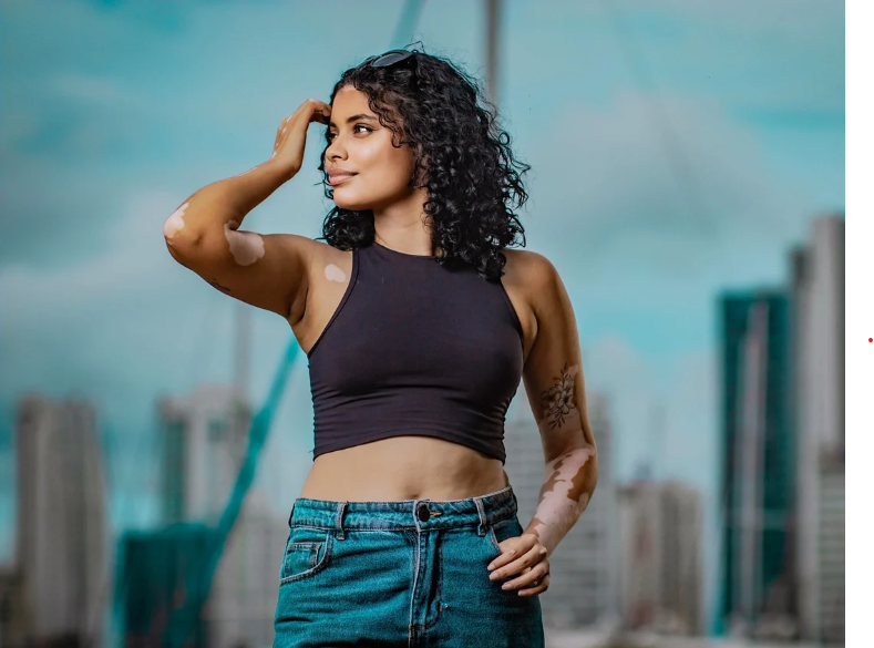 백반증(Vitiligo)이란? 피부에 나타나는 하얀 반점의 원인과 관리법