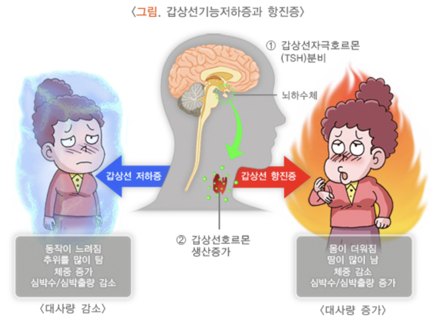 갑상선기능저하증과 항진증