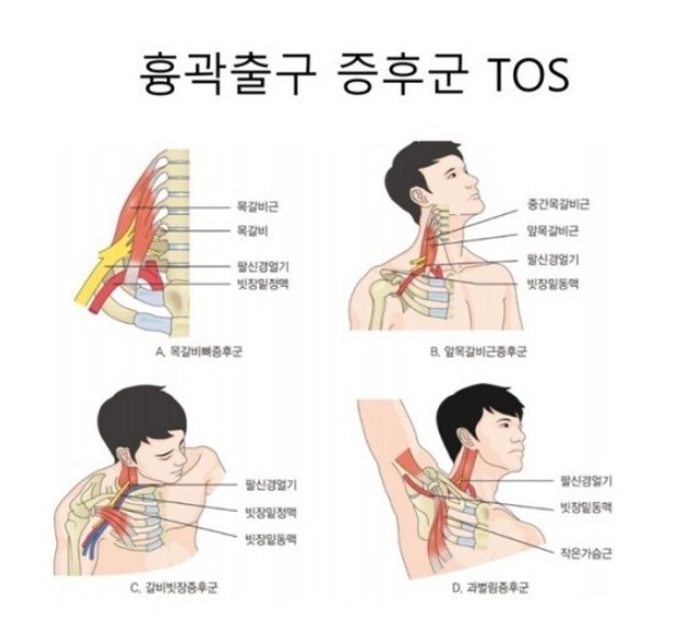 흉곽출구증후군