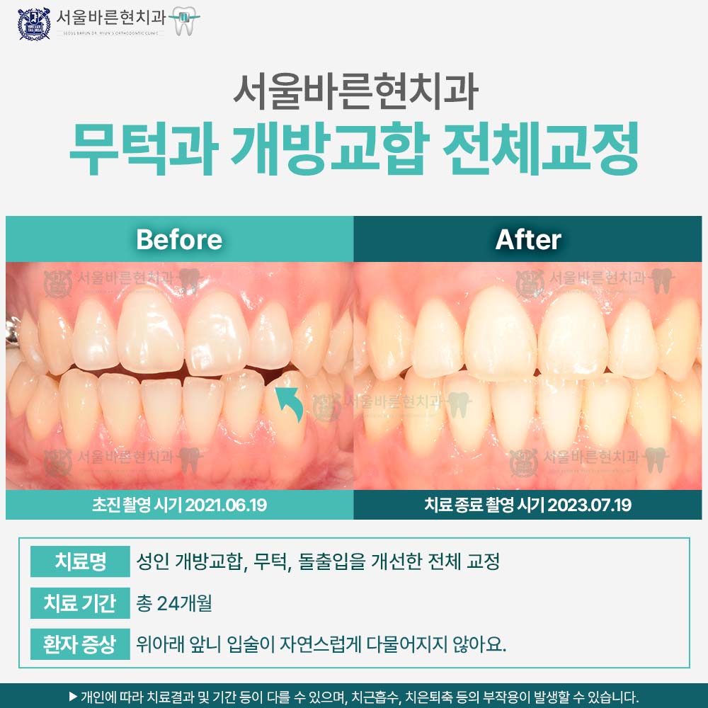 마린시티치아교정