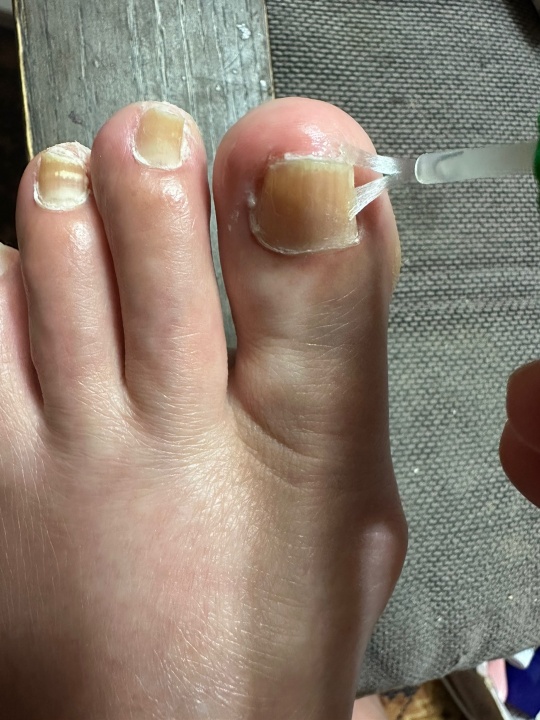 발톱 무좀 재발 방지 습관