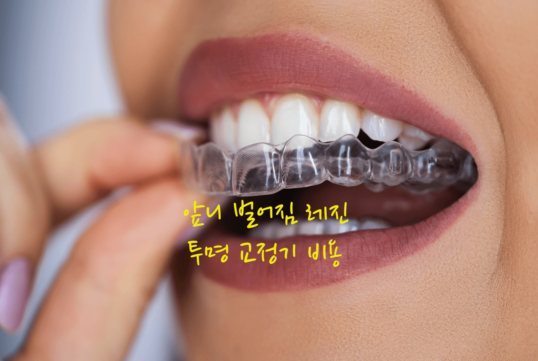 앞니 벌어짐 레진