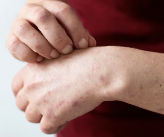 대상포진 초기증상 6