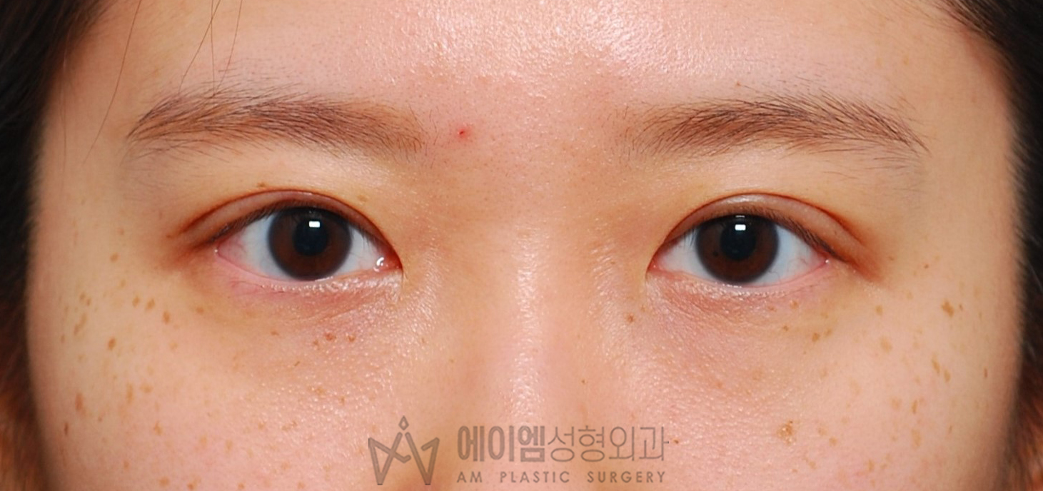 소세지눈 두줄따기 1개월 정면