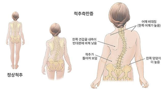 척추측만증 증상
