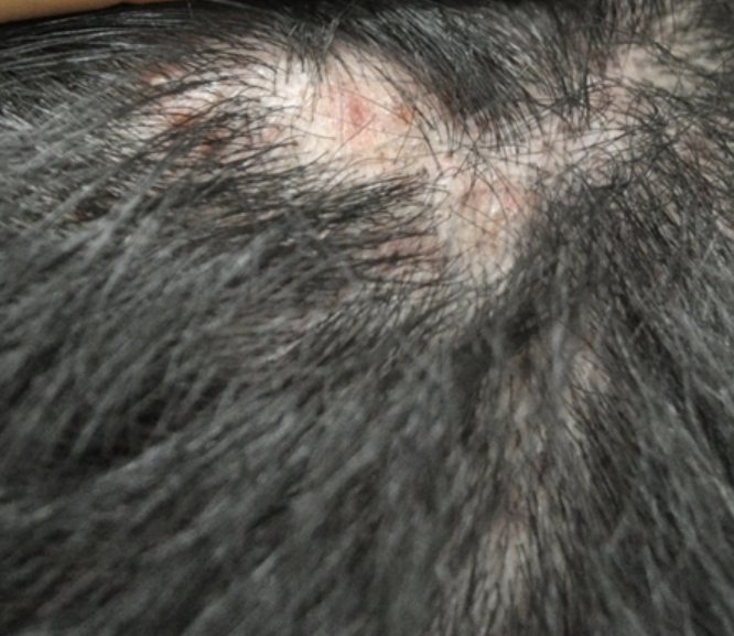 두피 가려움증 원인 2