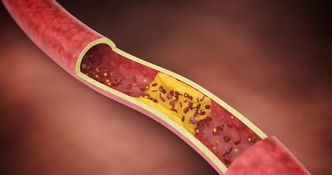 뇌경색 전조증상