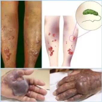 패혈증이란 무엇인지 원인 증상 치료 예방법_15