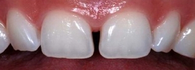 벌어진-앞니-레진-비용