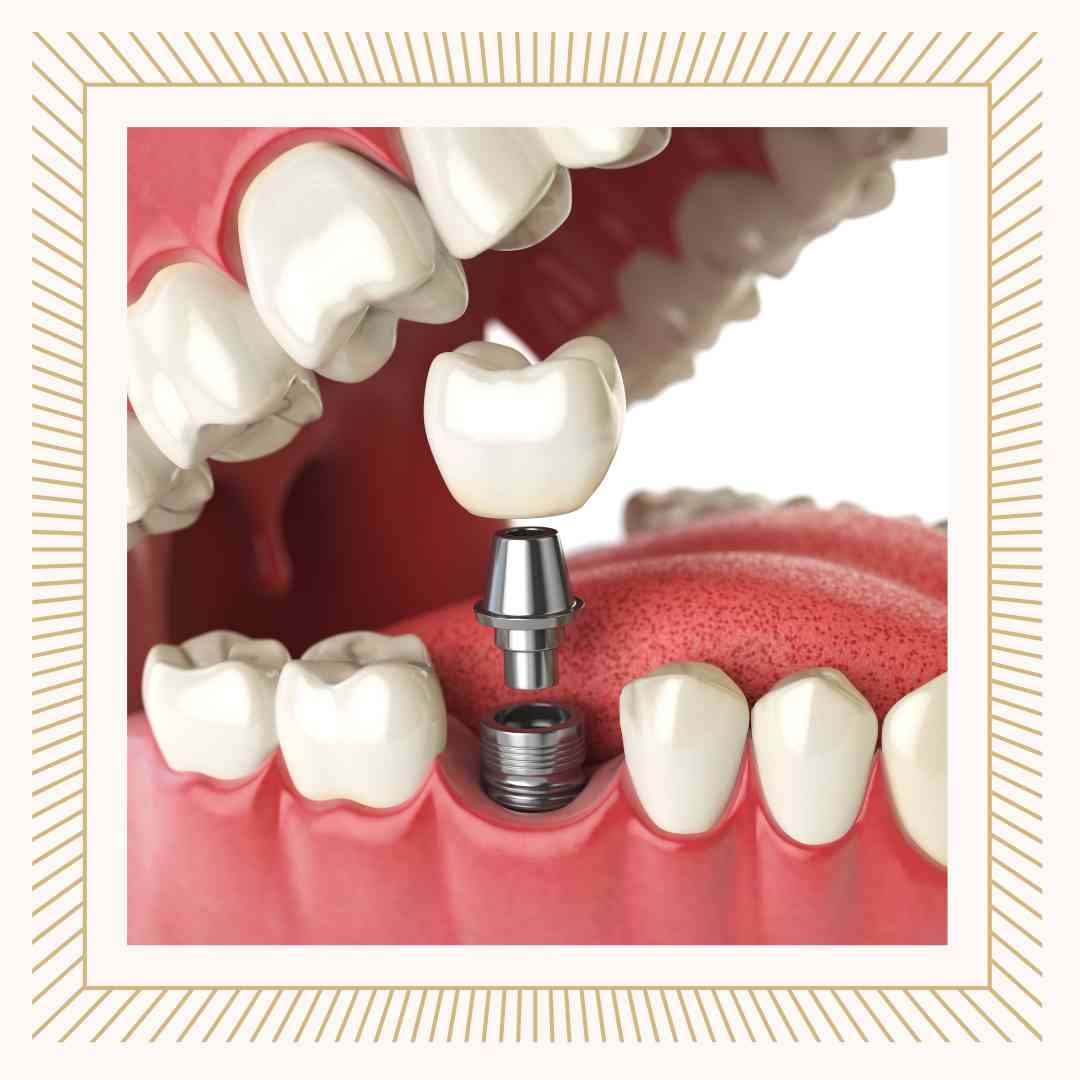 임플란트 건강보험