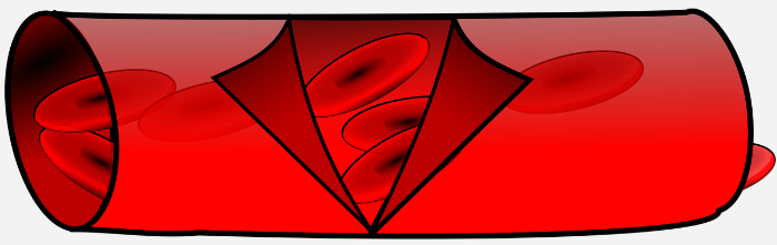 고지혈증으로 혈관에 콜레스테롤이 쌓여 동맥이 좁아지는 동맥경화 설명 일러스트