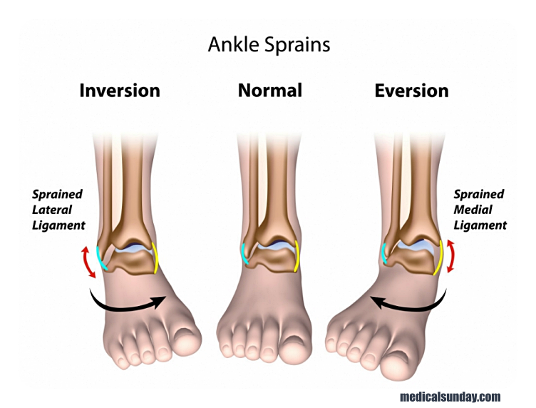 발목 접질렀을때 붓는 이유 : 발목 염좌