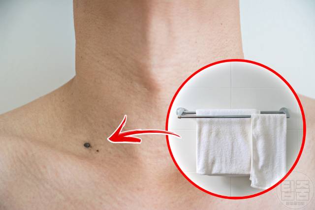 목 사마귀 제거 연고