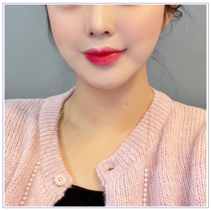 윤곽주사 후기