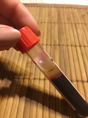 간수치높은이유-혈액사진