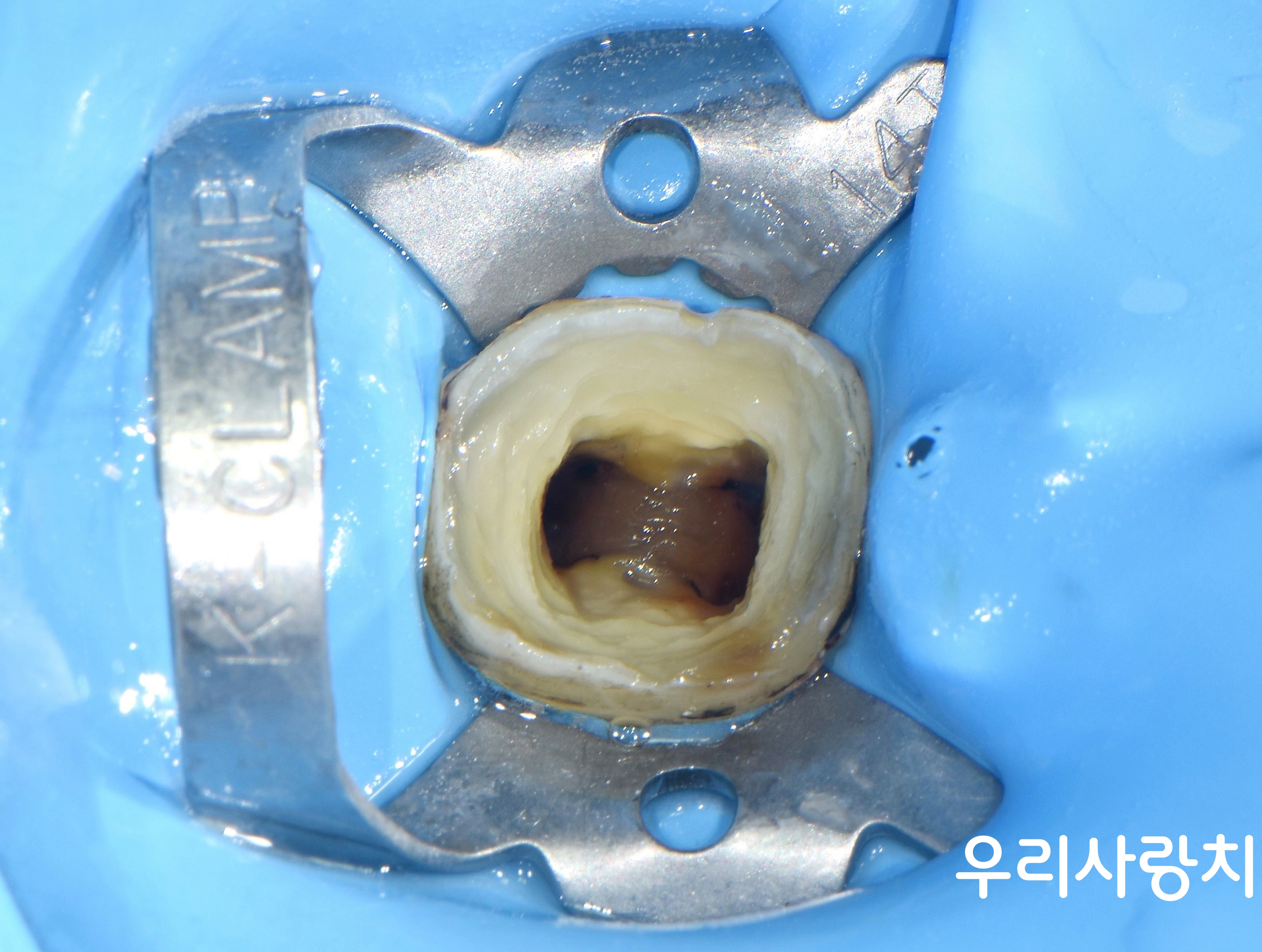 어금니 신경치료를 위한 러버댐