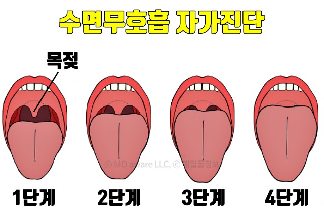 목젖, 수면무호흡증 증세 자가진단, 양압기, 수면 습관, 건강