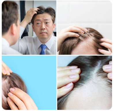 탈모 증상