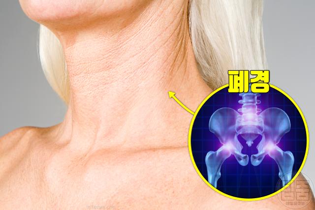 목주름 생기는 이유 폐경 골다공증