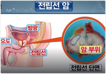 전립선암 초기증상 생존율 원인 수술방법 좋은음식