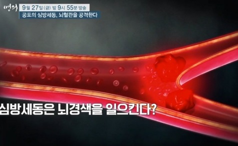 뇌경색유발