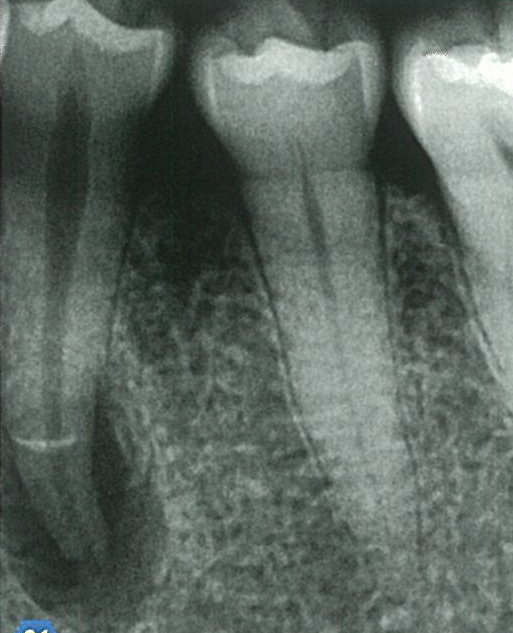 오래된 감염 근관의 방사선 사진