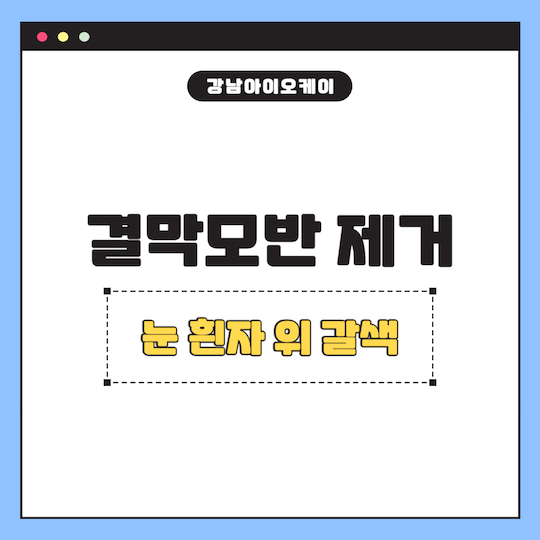 결막모반-제거