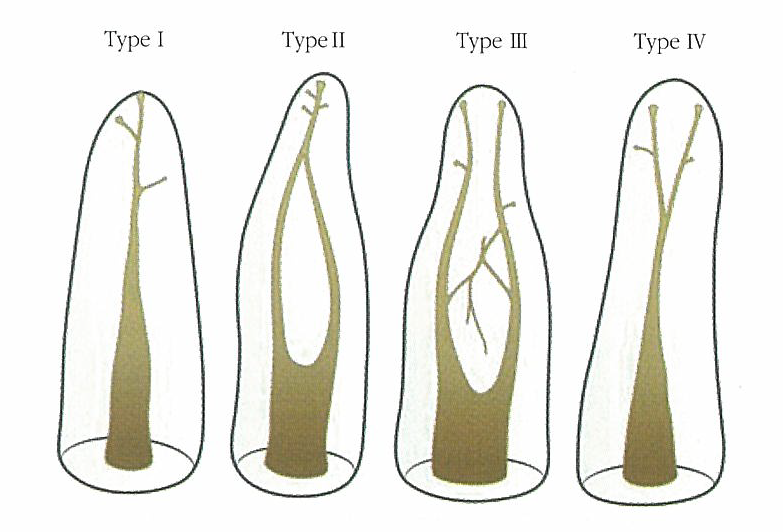근관의 형태 분류