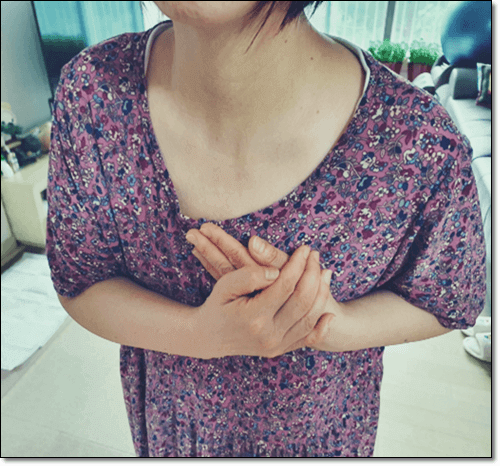 협심증 전조 증상이 있는 여성