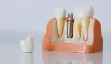 65세이상-임플란트-정부지원-받는방법