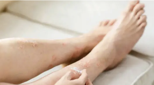 하지 정맥류 증상 14