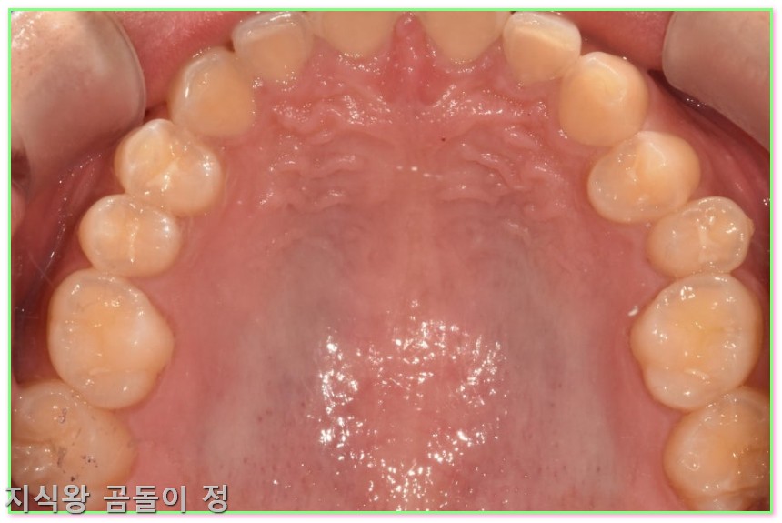 라미네이트 란? 앞니 벌어짐 해결 빠른 치료와 관리법 정리3