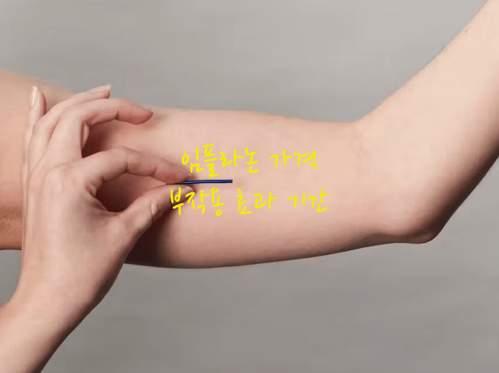 임플라논