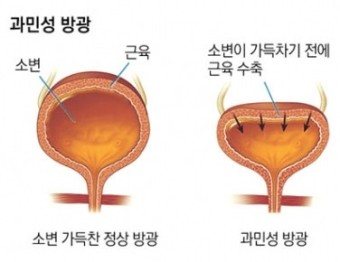 소변을 참을 수 없는 과민성 방광