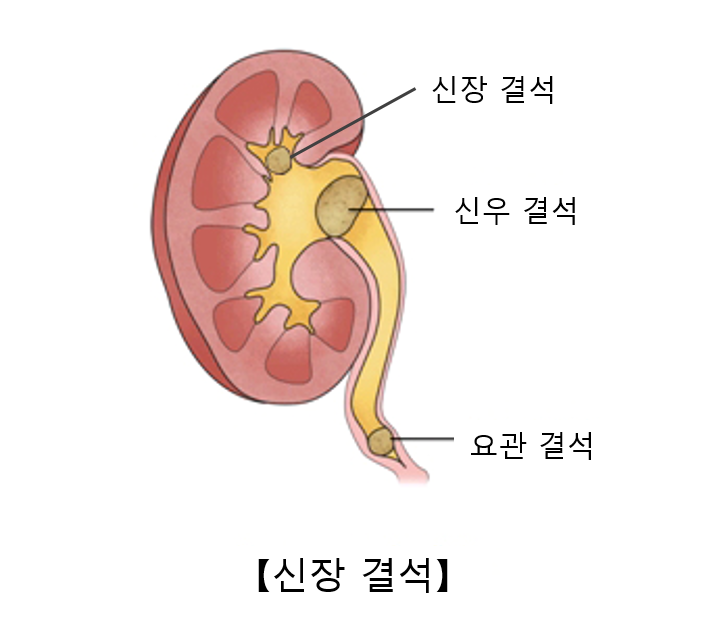 요로결석 증상과 원인, 치료 방법