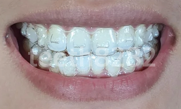 인비절라인-이란?