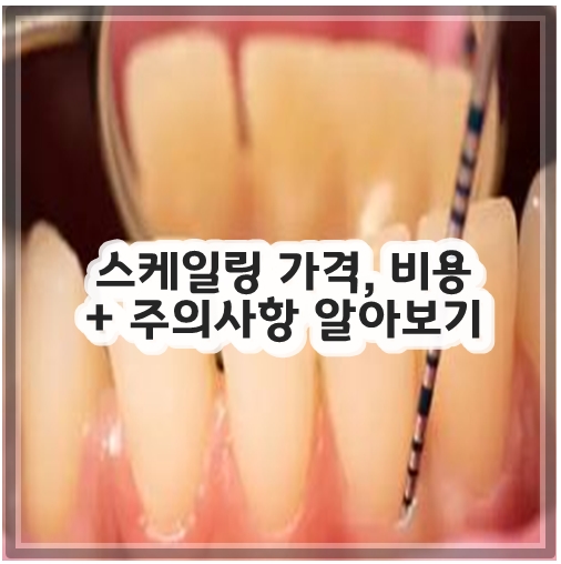 스케일링 가격, 비용 + 주의사항 알아보기