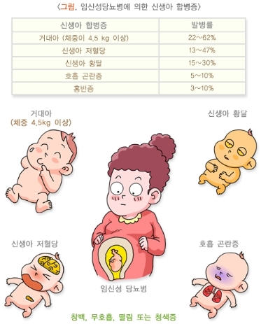 임신성 당뇨 증상