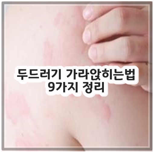 두드러기 가라앉히는법 9가지 정리