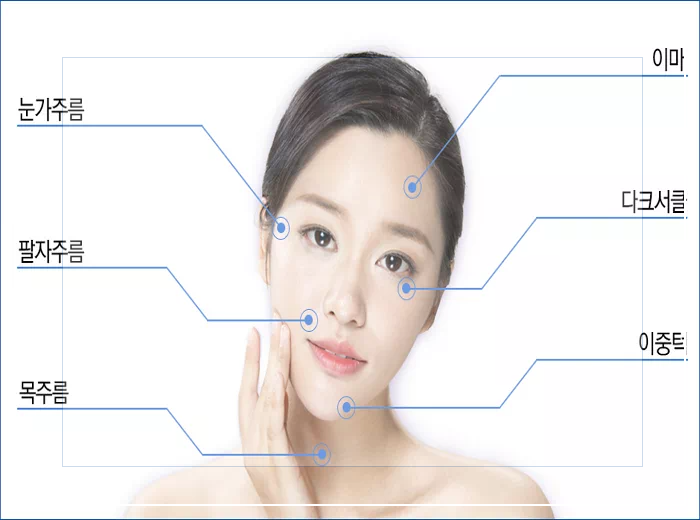 울쎄라 시술부위