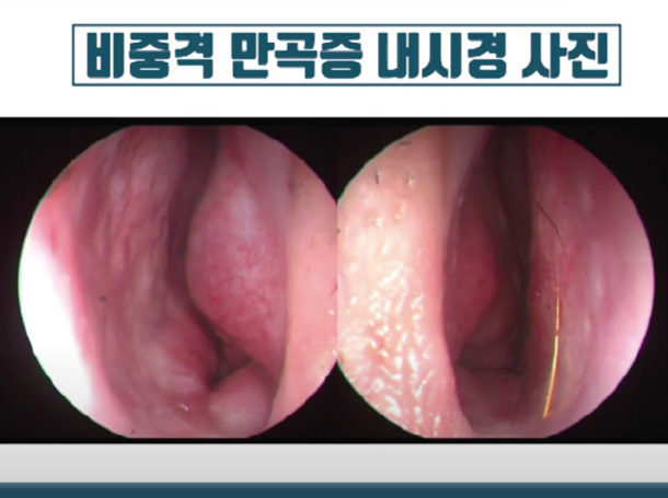 비중격만곡증-사진