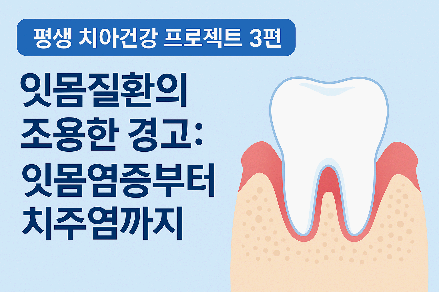 평생 치아건강 프로젝트 3편 - 잇몸질환의 조용한 경고(잇몸염증부터 치주염까지)