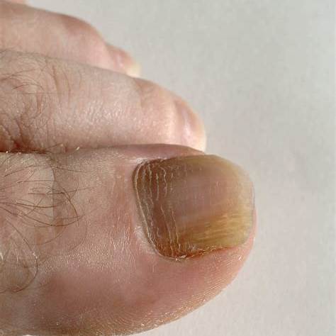 발톱 색 변색의 주요 증상 및 자가진단