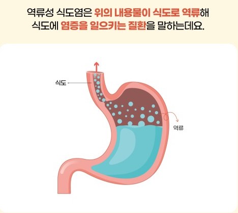 역류성식도염
