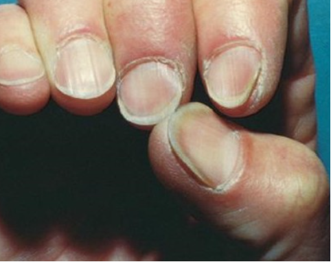 스푼형 손톱 사진