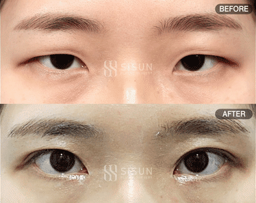 남자 눈매 교정술