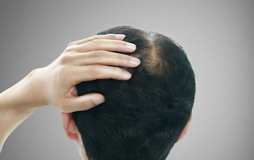 원형,M자,정수리탈모 증상 치료