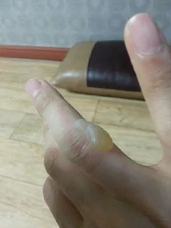 2도 화상 증상 자가치료 회복기간 응급처치법 정리_21