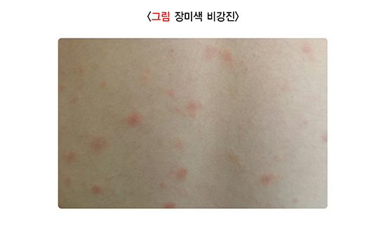 장미색비강진, 지베르장미색비강진, 피부발진, 크리스마스트리발진, 피부가려움증